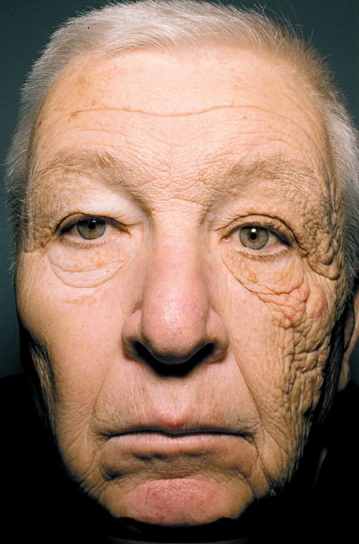 An older man's face photographed head-on: one side is deeply wrinkled, thickened and sagging from decades of UVA exposure through a vehicle window, while the more protected side looks markedly smoother.