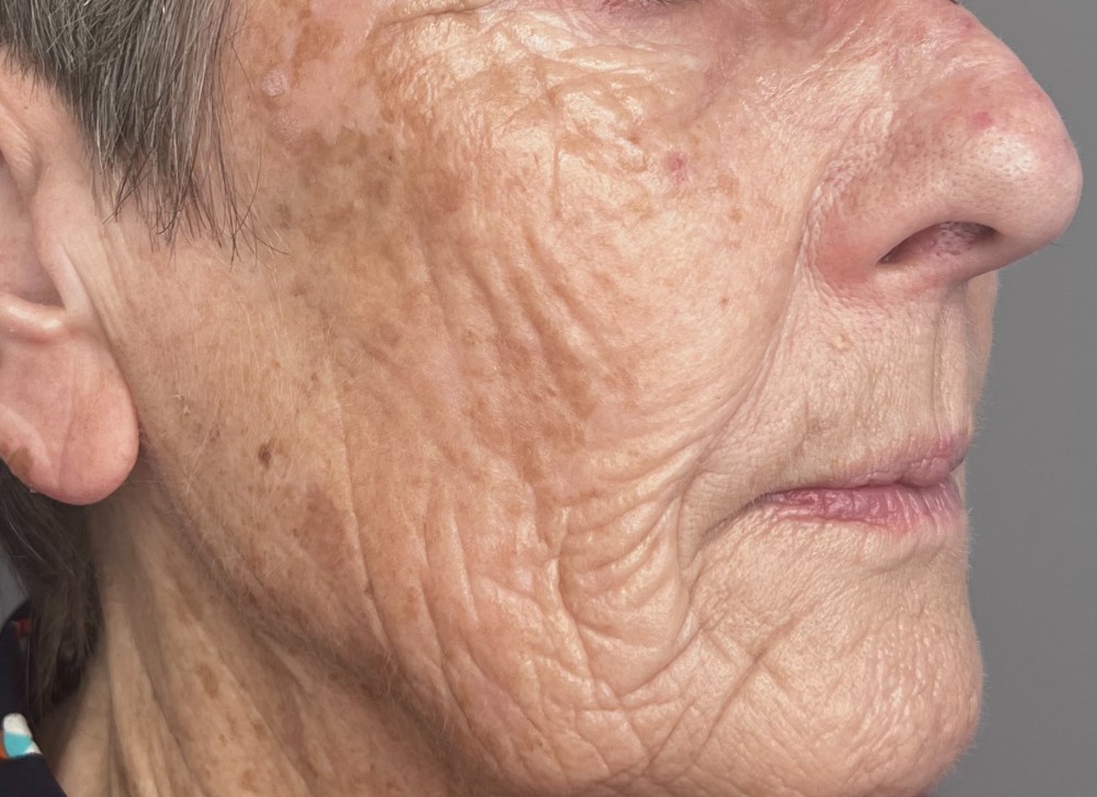 TCA peel result, after treatment &mdash; cheek