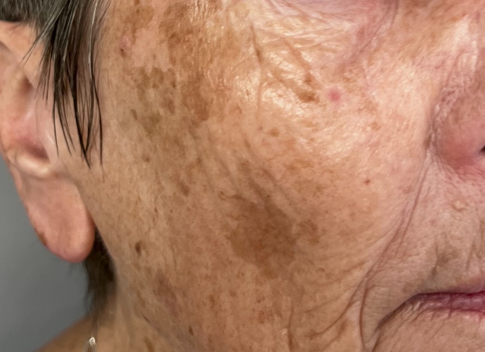 TCA peel result, before treatment &mdash; cheek